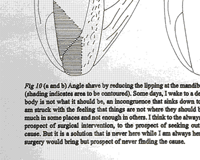 Black and white image of a medical diagram with text caption.